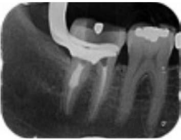 the distal root canal; b-d) sagittal, coronal, and axial CBCT cross-sections confirm the internal resorption without