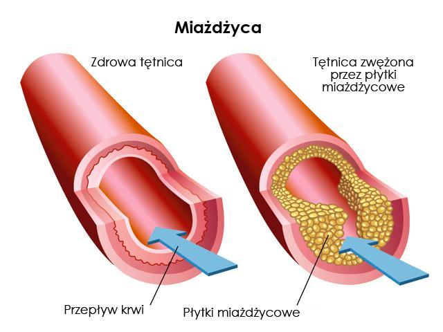 Miażdżyca Czynniki wpływające na rozwój miażdżycy, możemy podzielić na takie, na które mamy wpływ i na niezależne od nas.