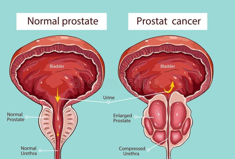 Stercz (prostata, gruczoł krokowy) Stercz, gruczoł krokowy lub prostata to różne nazwy tego samego narządu męskiego.