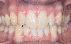 Łuki ortodontyczne BioLingual