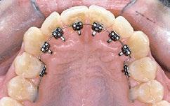 łuki ortodontyczne FORESTADENT