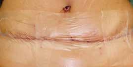 abdominis (zwisający wór brzuszny po znacznej utracie wagi) Poprzednie leczenie/choroby