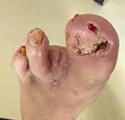 octenidine-based products in modern wound management; Journal of Wound Care, 25(3), S1-S28,