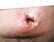 Matiasek: The Combined use of NPWT and instillation using octenidine based wound