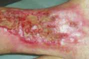 octenidine and octenidinebased products in modern wound management.