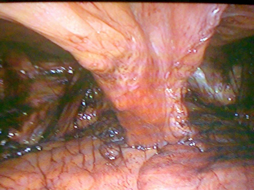 Hernioplastika W roku 2004-10981 hernioplastyk 7,0 % 2005 wzrost absolutny i relatywny 8,6 % 766 laparoskopowoi, Absolutny limit