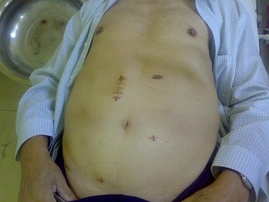 postoperative course