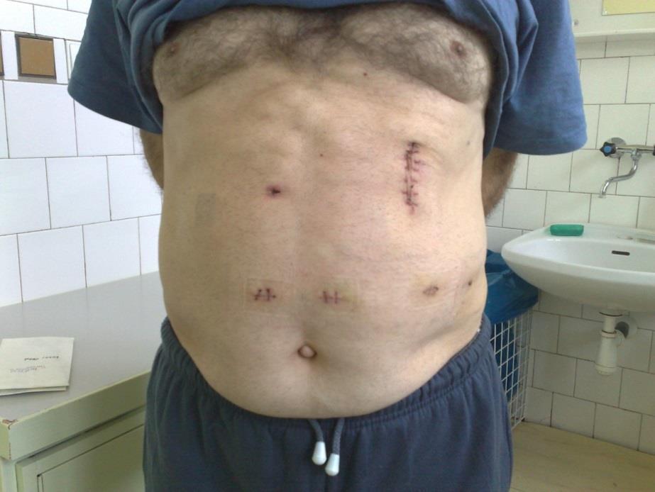 Gastroduodenum/Żołądek, dwunastnica Razem 110 zabiegów Wagotomie elektywnie praktycznie zaniknęły Resekcje łagodne i złośliwe 9 x / 1x ulkus, 8x Ca / 3x BII, 3x subtotalna, 2x totalna, 1x klinowa