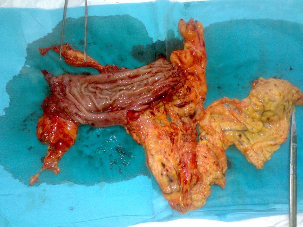 limfadenektomia Od r 2007