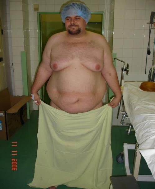 Bariatric surgery Częste stosowanie różnych metod 3