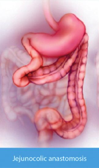 Some types of intestinal resection Fizyczna utrata: zazwyczaj jest skutkiem konieczności resekcji znacznego odcinka jelit podczas operacji, może być również następstwem