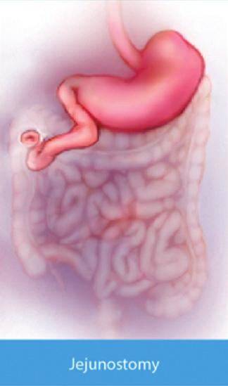 Utrata prawidłowej funkcji jelit: jest rzadziej spotykana, diagnozowana jest w sytuacji gdy Pacjent nie jest w stanie przyswoić wystarczającej ilości wartości odżywczych pomimo,
