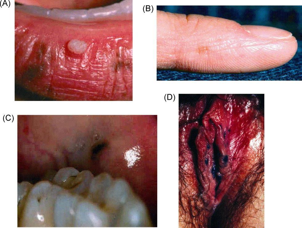 sciencedirect.com/science/article/pii/s1096719203000064 Rothenbuhler A, Stratakis CA.