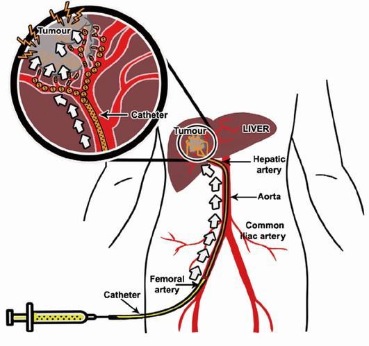 Ryc.4. Chemoembolizacja tętnicza (TACE) Żródło: Wang Y., De Baere T., Idee J., Ballet S., Transcatheter embolization therapy in liver cancer: an update of clinical evidences.