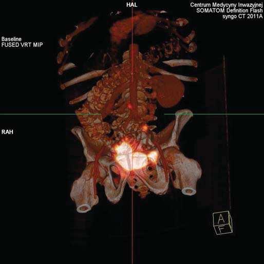 Figure 1. SPECT / CT lymphoscyntygraphy with 3D reconstruction in a patient with bladder cancer.