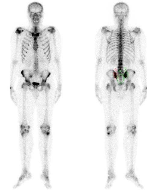 Osteoartropatia młodzieńcza Mężczyzna, 18 lat, podejrzenie osteoartropatii młodzieńczej Planarne badanie scyntygraficzne układu kostnego z wykorzystaniem 99m Tc-MDP Uwidoczniono obszary wzmożonego