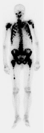Superscan Mężczyzna, 85 lat, rak prostaty w wywiadzie Badanie scyntygraficzne układu kostnego z zastosowaniem 99m Tc-MDP w celu oceny pod kątem obecności przerzutów do kości Wzmożone gromadzenie