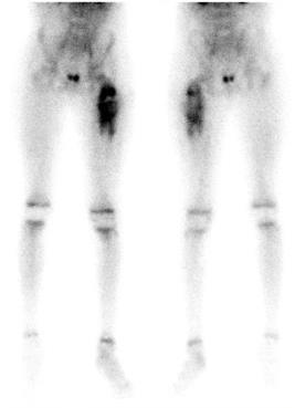 scyntygraficzne układu kostnego z zastosowaniem 99m