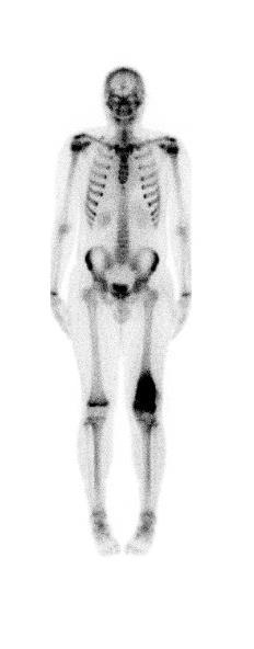 Osteosarcoma Chłopiec, 16 lat, potwierdzony histopatologicznie osteosarcoma lewej kości udowej Trójfazowe badanie scyntygraficzne z