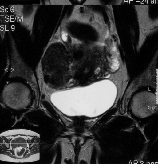 Pol J Radiol, 2006; 71(1): 53-58 MR imaging of lesions mimicking ovarian tumors wysokopolowych tak sta o si w przypadku wy ej opisanej pacjentki z ektopowà nerkà miednicznà.