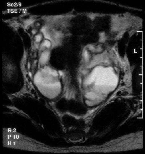 Original rticle Pol J Radiol, 2006; 71(1): 53-58 Figure 3. TSE/T2/. ilateral pyosalpinx. The normal right ovary is shown. a) axial, b) coronal.