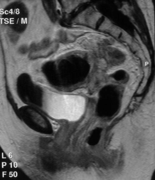Pol J Radiol, 2006; 71(1): 53-58 MR imaging of lesions mimicking ovarian tumors Figure 5.