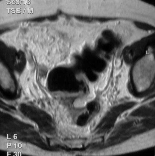 Guz jelita grubego u chorej po usunięciu narządu rodnego przed wieloma laty i z podejrzeniem wznowy guza jajnika. a) sag, b) ax. Figure 6. TSE/T2. enign polycystic mesothelioma.