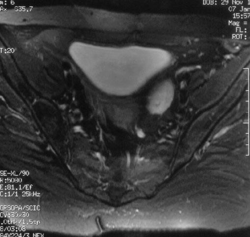 Original rticle Pol J Radiol, 2006; 71(1): 53-58 Figure 7. FSE/T2fatsat/axial. Ectopic pelvic left kidney (courtesy of H.