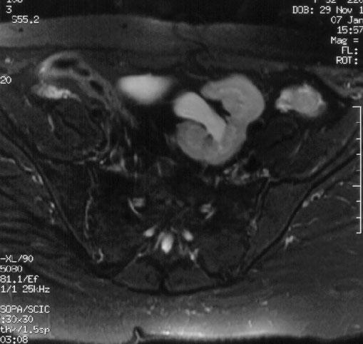 Ektopowa lewa nerka położona w miednicy (zdjęcia z Zakładu Diagnostyki Obrazowej Instytutu Matki i Dziecka w Warszawie; za zgodą z-cy Kierownika Zakładu, dr n. med. H. rągoszewskiej).