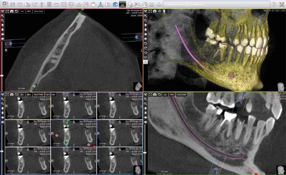 CHCĘ MIEĆ PROGRAM PLANOWANIA IMPLANTÓW LEPSZĄ JAKOŚĆ ŻYCIA TWOICH PACJENTÓW