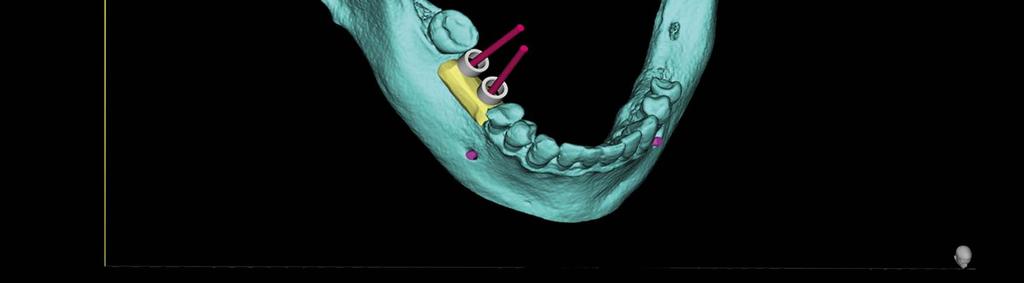 CHCĘ ULEPSZYĆ DIAGNOZĘ I ZABIEG OBLICZANIE OBJĘTOŚCI BIOMATERIAŁU