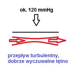 wartość ciśnienia skurczowego uznaje się wartość ciśnienia przy którym ponownie wyczuto tętno - początek przepływu burzliwego (turbulentnego) krwi (Rysunek 3). Metoda Korotkowa Rysunek 3.