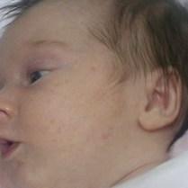 zmiany trądzikowe u niemowląt zmiany trądzikowe u niemowląt zmiany trądzikowe u niemowląt