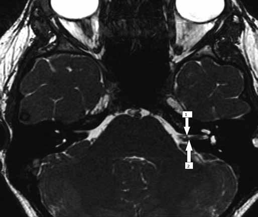 Orendorz-Frączkowska K. Trudności diagnostyczno-kliniczne w otoneurologii dziecięcej 231 Ryc. 3. Badanie MRI dziewczynki (przypadek 1).