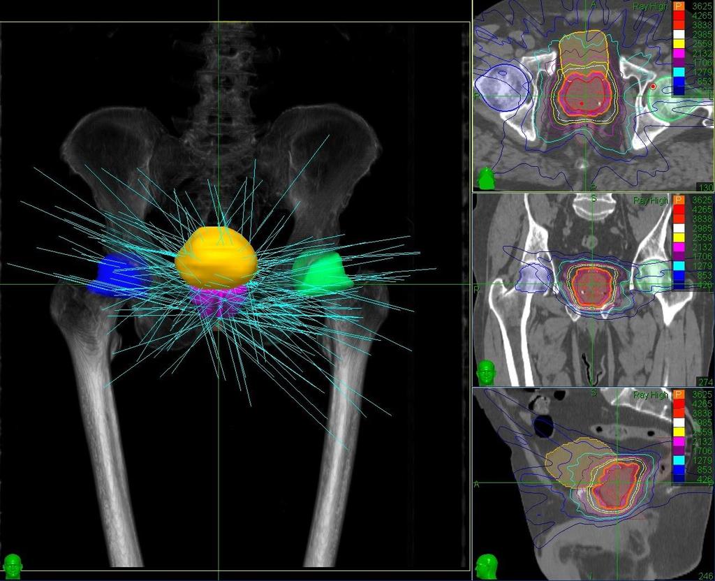 Prostate Template Path