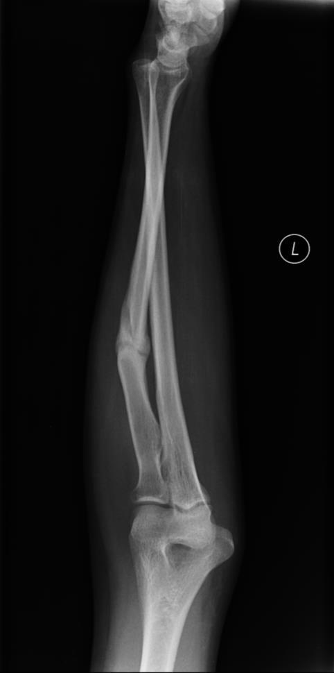 Nieprzemieszczone izolowane złamanie trzonu kości łokciowej jest w praktyce jedynym wskazaniem do leczenia zachowawczego złamań trzonów kości przedramienia u dorosłych, poza ogólnymi