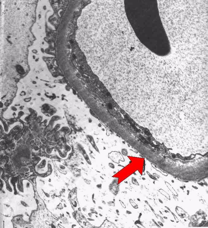 FSGS