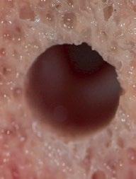 Niezrównana precyzja X-Runner zastępuje wiele narzędzi dentystycznych i sprawia, że