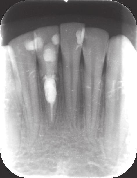 J Stoma 2013; 66, 1 Lempe B., Markunina M. Fig. 1. Case 1. Radiograph of tooth 41 with internal resorption. Przypadek 1. Zdjęcie radiologiczne zęba 41 z resorpcją wewnętrzną korzenia. Fig. 2. Case 1. Radiograph of tooth 41 after obturation with MTA.