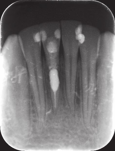 Zdjęcie radiologiczne zęba 41 po 6 miesiącach od zabiegu. Fig. 4. Case 1. Radiograph of tooth 41after 12 months. Przypadek 1. Zdjęcie radiologiczne zęba 41 po 12 miesiącach od zabiegu.