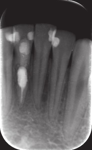 The root canal was temporarily filled with non-hardening calcium-hydroxide-based material (Biopulp, Chema, Rzeszów, Poland), and after 7 days MTA cement was applied (Pro Root MTA Dentspaly,