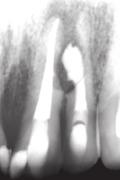 J Stoma 2013; 66, 1 Lempe B., Markunina M. Fig. 5. Case 2 Radiograph of tooth 21 and 22 with internal and external root resorption. Przypadek 2.