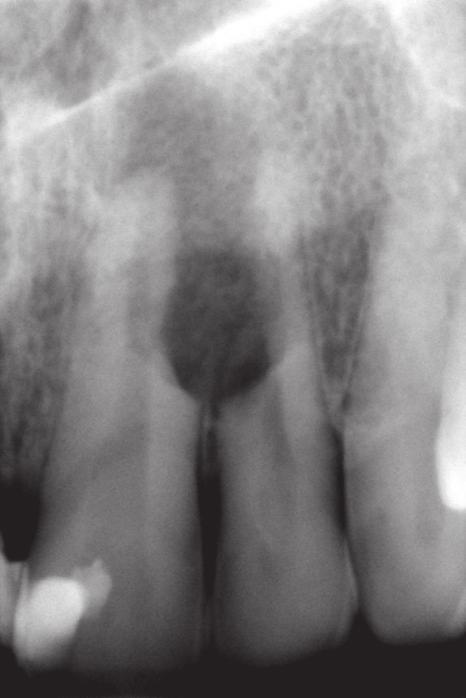 Zdjęcie radiologiczne ząba 21 po zabiegu wypełnienia kanału korzeniowego pastą AH Plus oraz zęba 22 po zabiegu wypełnienia kanału korzeniowego materiałem MTA. Fig. 7. Case 2.