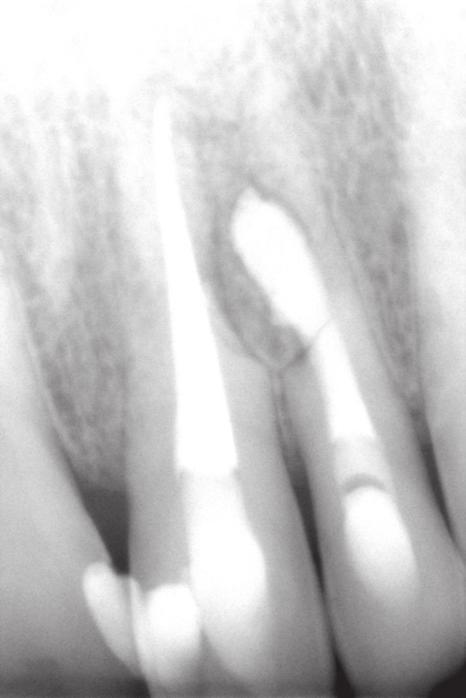 Chema, Rzeszów, Poland) and then, together with resorption cavity, it was completely filled with MTA (Pro Root MTA Dentspaly, Switzerland).