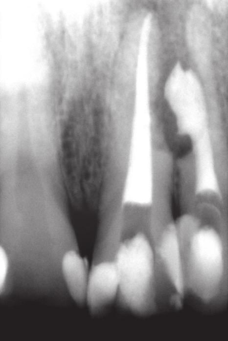 A follow-up examination after 6 months showed good clinical condition of teeth 21 and 22; no mobility and good condition of periodontium and X-ray film showed that resorption had stopped (Fig. 7).
