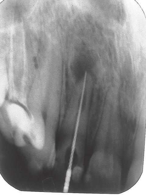 Using MTA in the treatment of internal and external root resorption... J Stoma 2013; 66, 1 the patient did not report for.