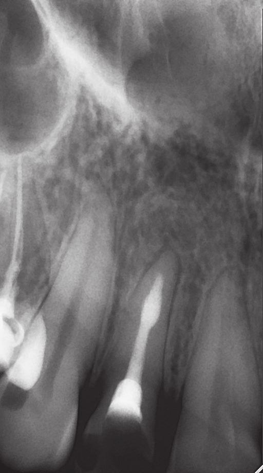 J Stoma 2013; 66, 1 Lempe B., Markunina M. Fig. 10. Case 3. Radiograph of tooth 22 after obturation with MTA and Endomethasone N. Przypadek 3.