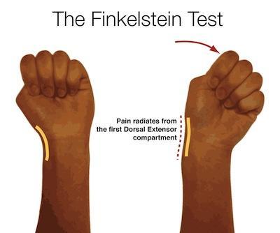Test Finkelsteina Test polega na zgięciu kciuka,