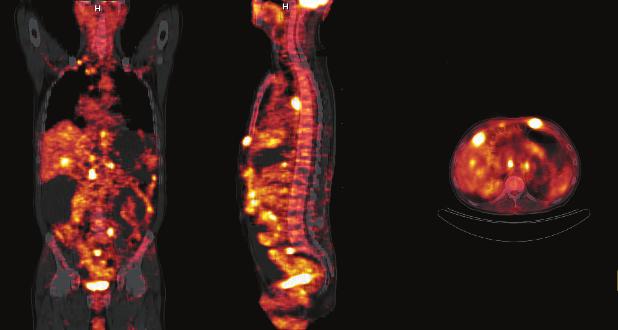 Po³¹czenie pozytonowej tomografii emisyjnej z tomografi¹ komputerow¹ (PET/CT) u chorych na raka o³¹dka pierwsze w³asne doœwiadczenia 215 Tabela 1.