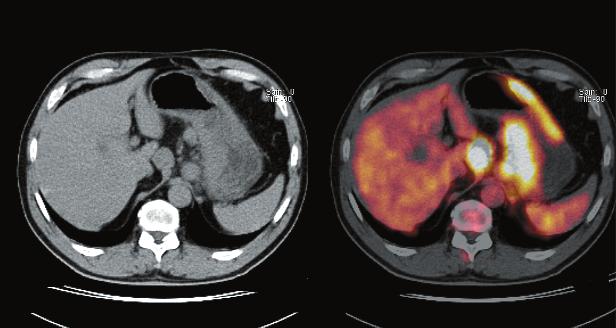 Patients' characteristics with identification of recurrent (1-7) and primary gastric cancer (8-12).